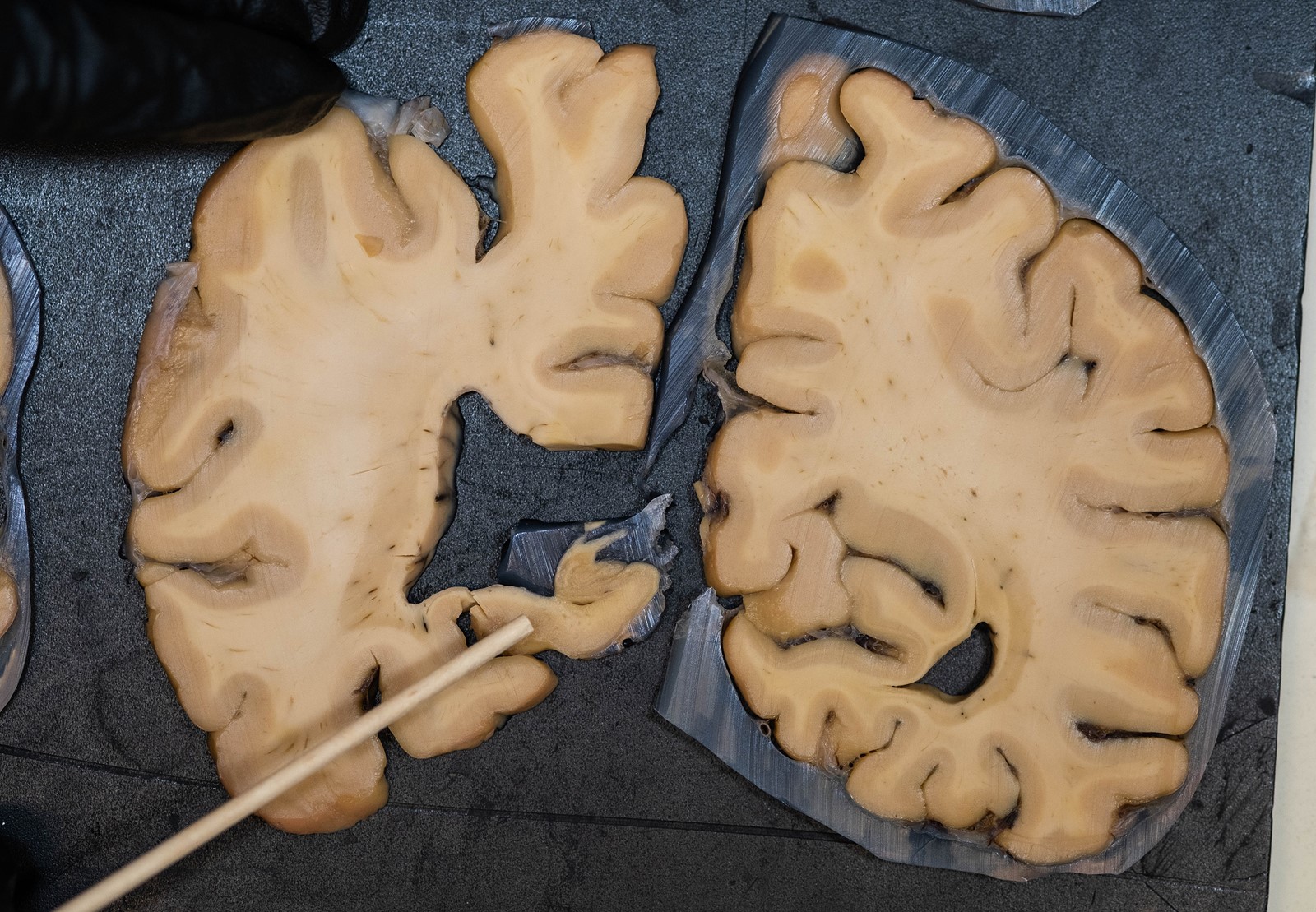 202511100400MCT_____PHOTO____US-NEWS-MED-CMP-UPITTSBURGH-BRAIN-BANK-SE_1099772800.jpg