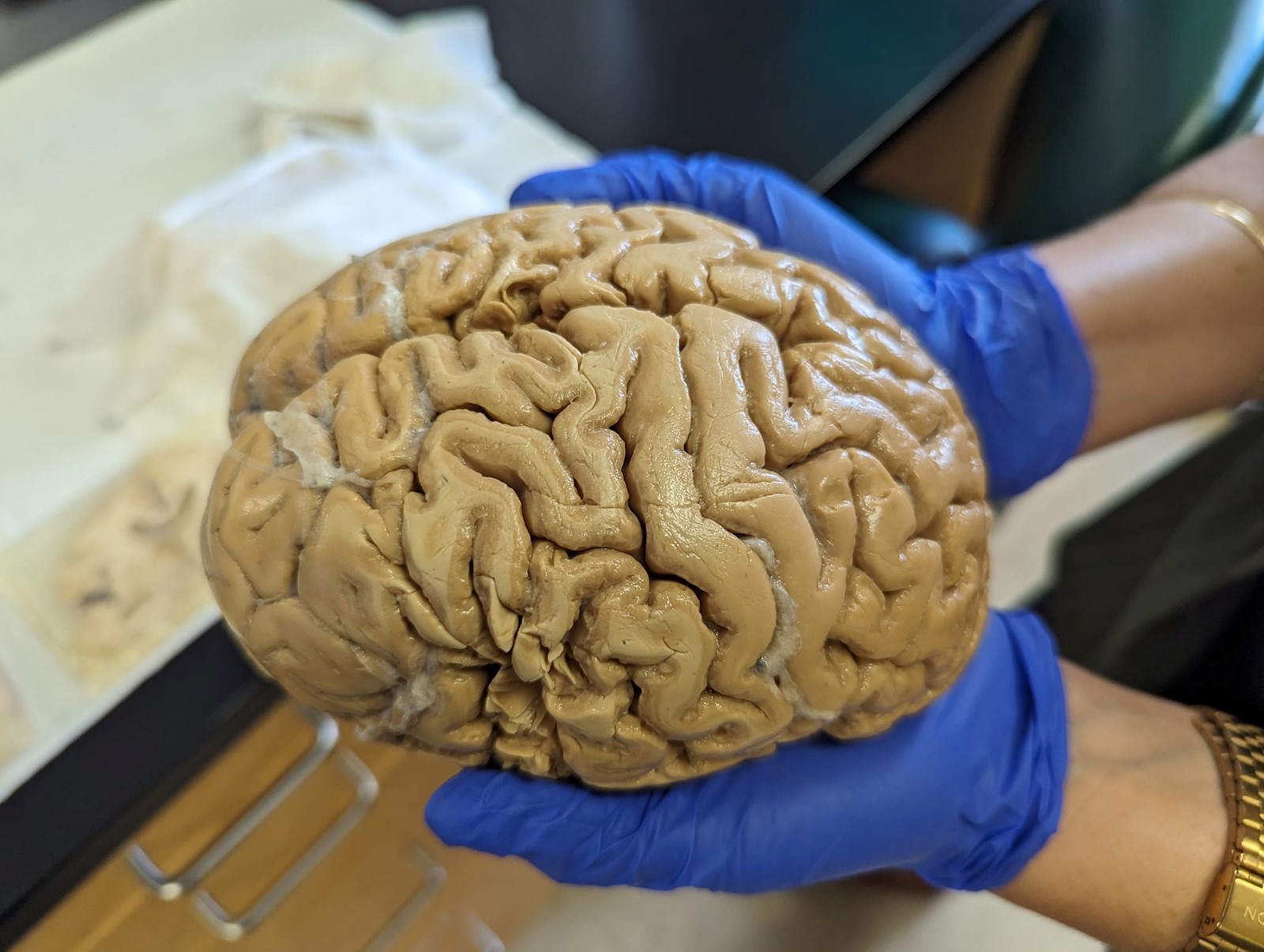 0715_NWS_OCR-L-SFORZA-ALZHEIMERS-0716-01_1095366945.jpg
